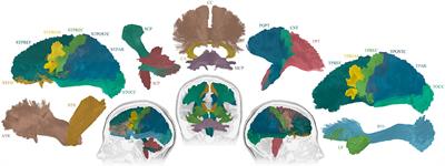 White matter alterations in focal to bilateral tonic-clonic seizures